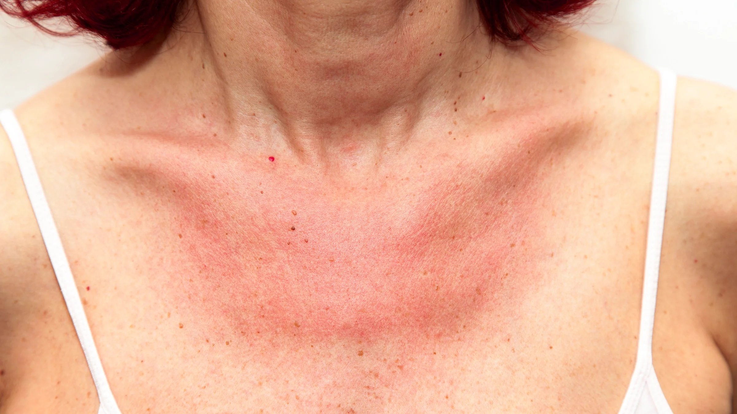 A person's chest is red and splotchy. Some people have an allergy to the sun, which causes an itchy and painful rash.