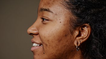 Health: Isotretinoin: closeup woman with acne 1463321953