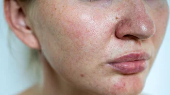 Dermatology: closeup rosacea on face 2170398268