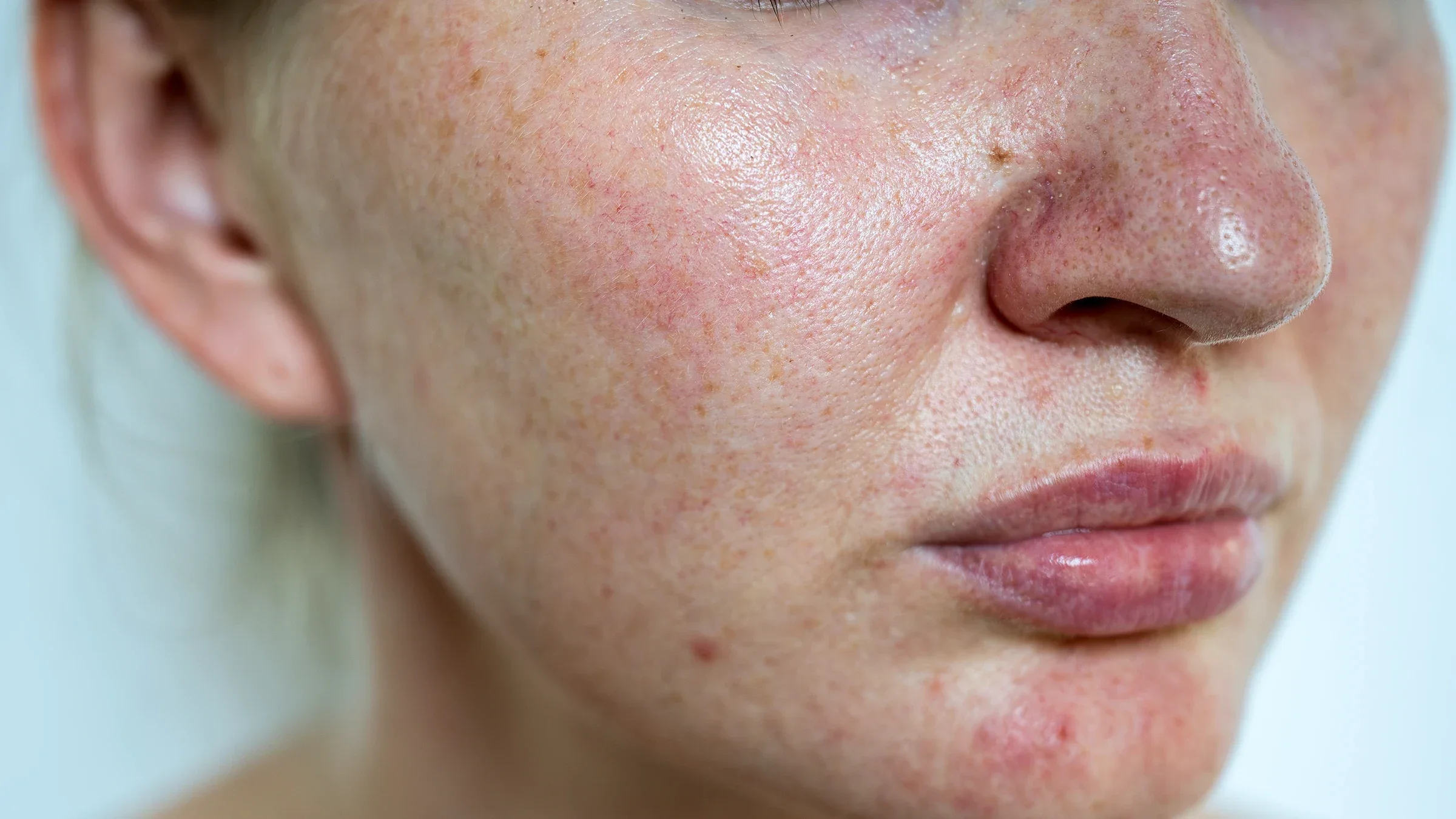 A close-up shows rosacea and freckles on a woman's face.
Anastasiia AkhiStock via Getty Images Plus         