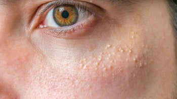 Health: Dermatology: closeup milia under eye 519167976