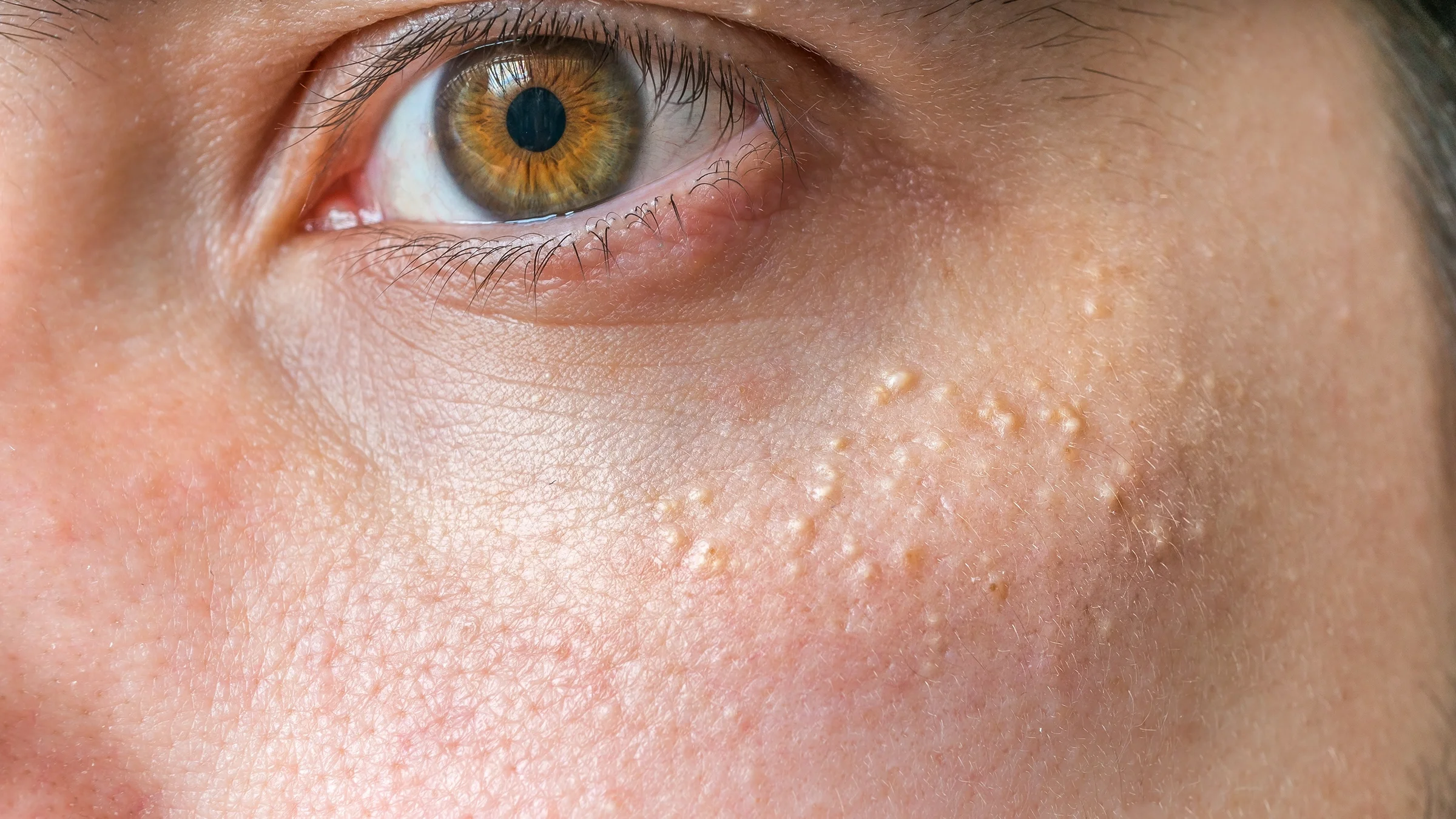 A person has bumps on the skin around their eye.