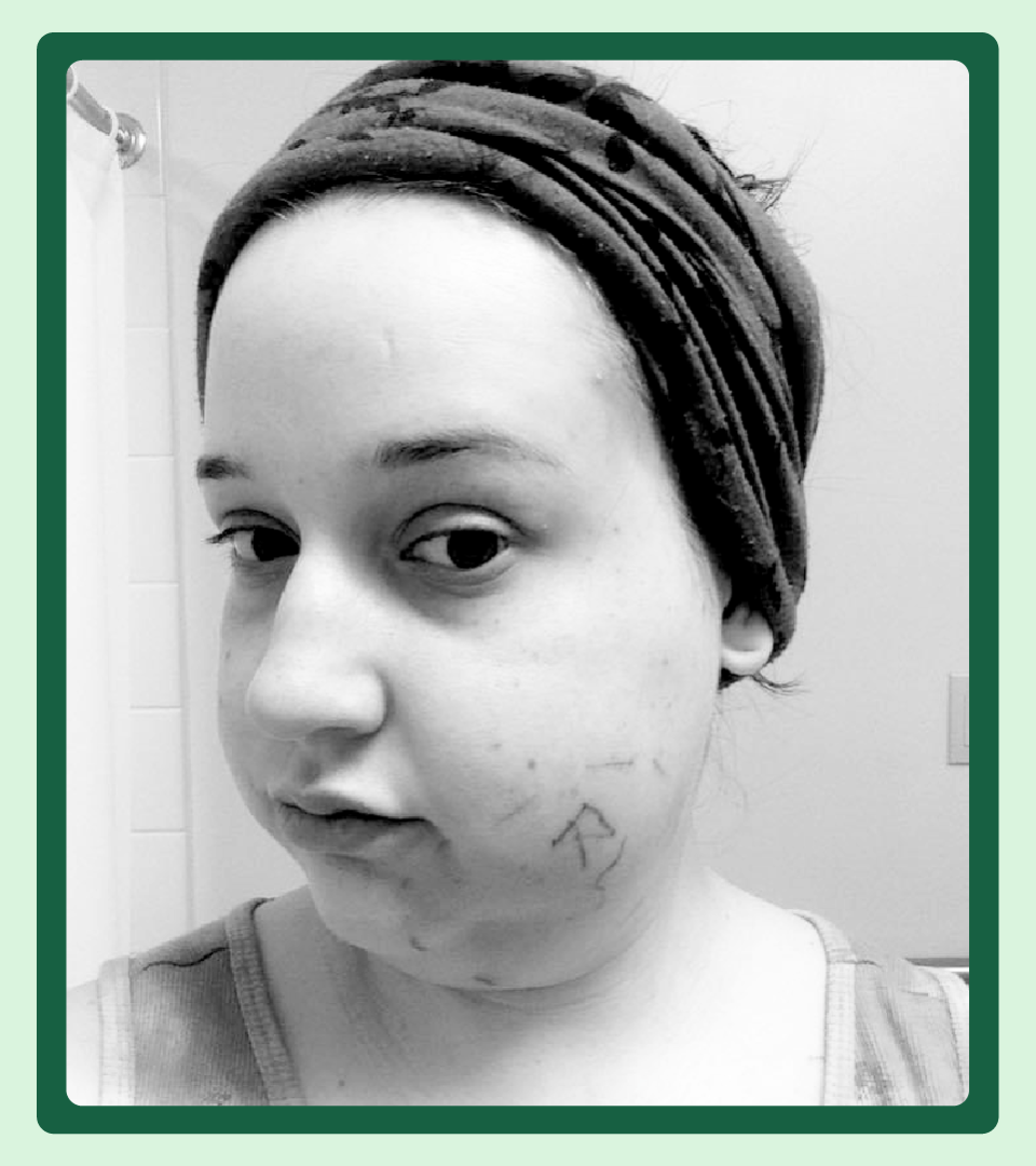 Aliyah Remetz is pictured in a selfie showing her swollen mouth.