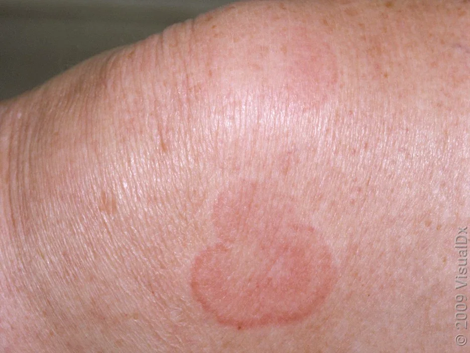 Smaller hives on the leg.