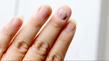 fungal-infection: hand: nails: nail damage-598959658