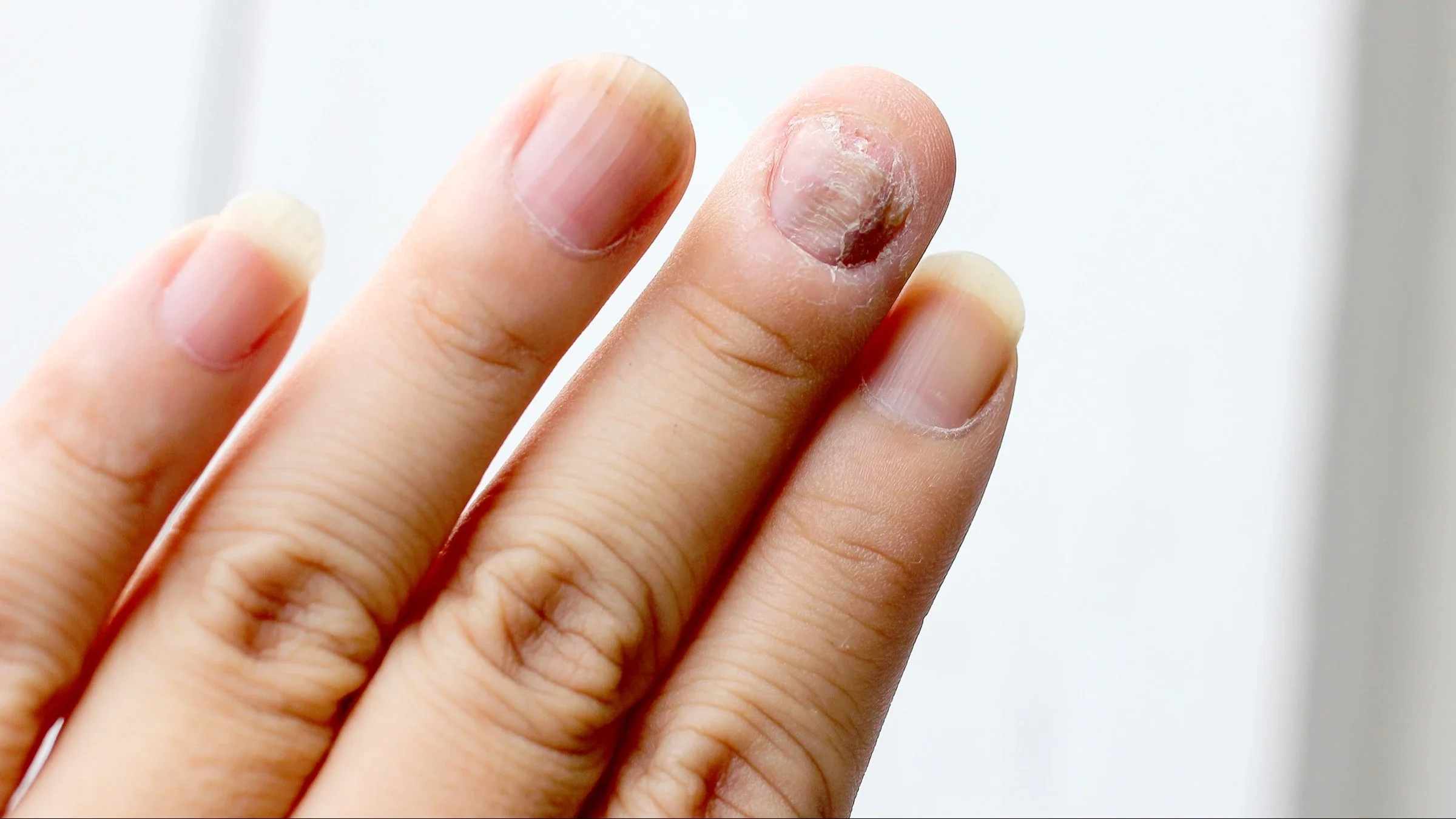 A close-up image on damaged nails.