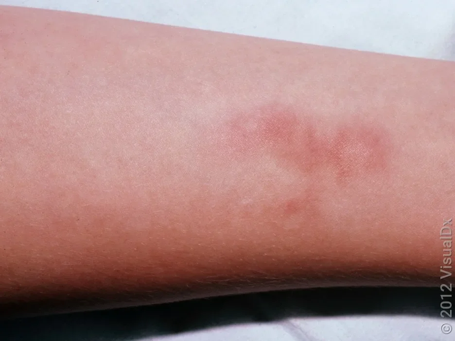 Close-up of erythema nodosum on the forearm.