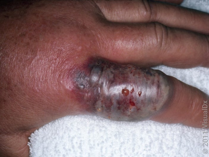 Cellulitis on a hand with an abscess.