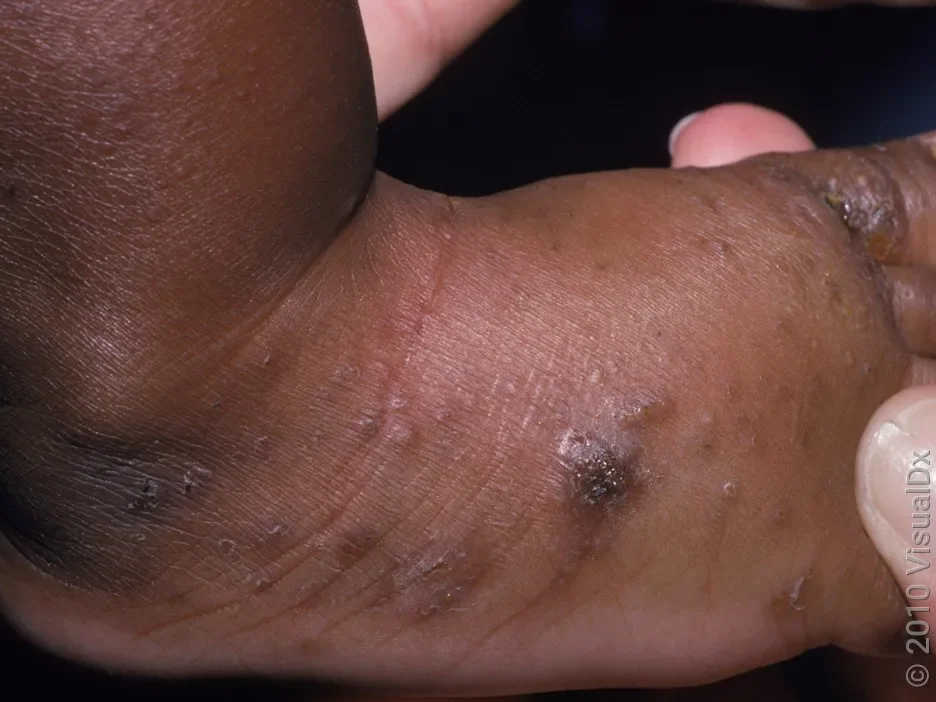 Close-up of an infant’s foot with clusters of pink, brown, and crusty bumps in scabies.