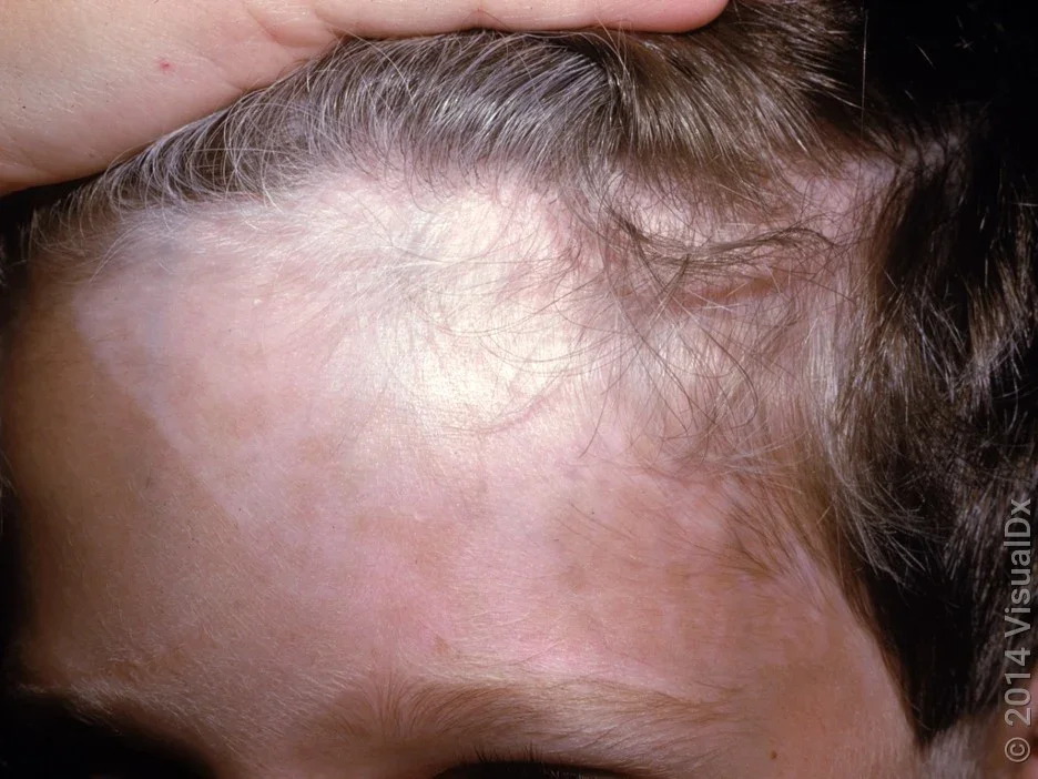 Close-up of vitiligo on the face.