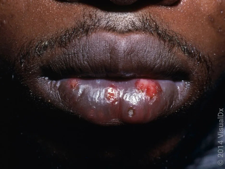 Close-up of open blisters from herpes.