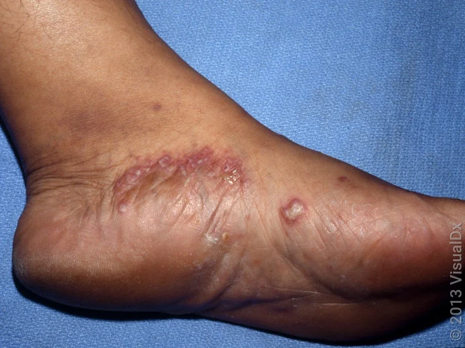 Tinea pedis (athlete’s foot) can cause a red, scaly rash and blisters. 