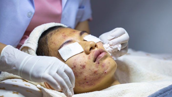 A person with severe acne getting a treatment from a dermatologist. 