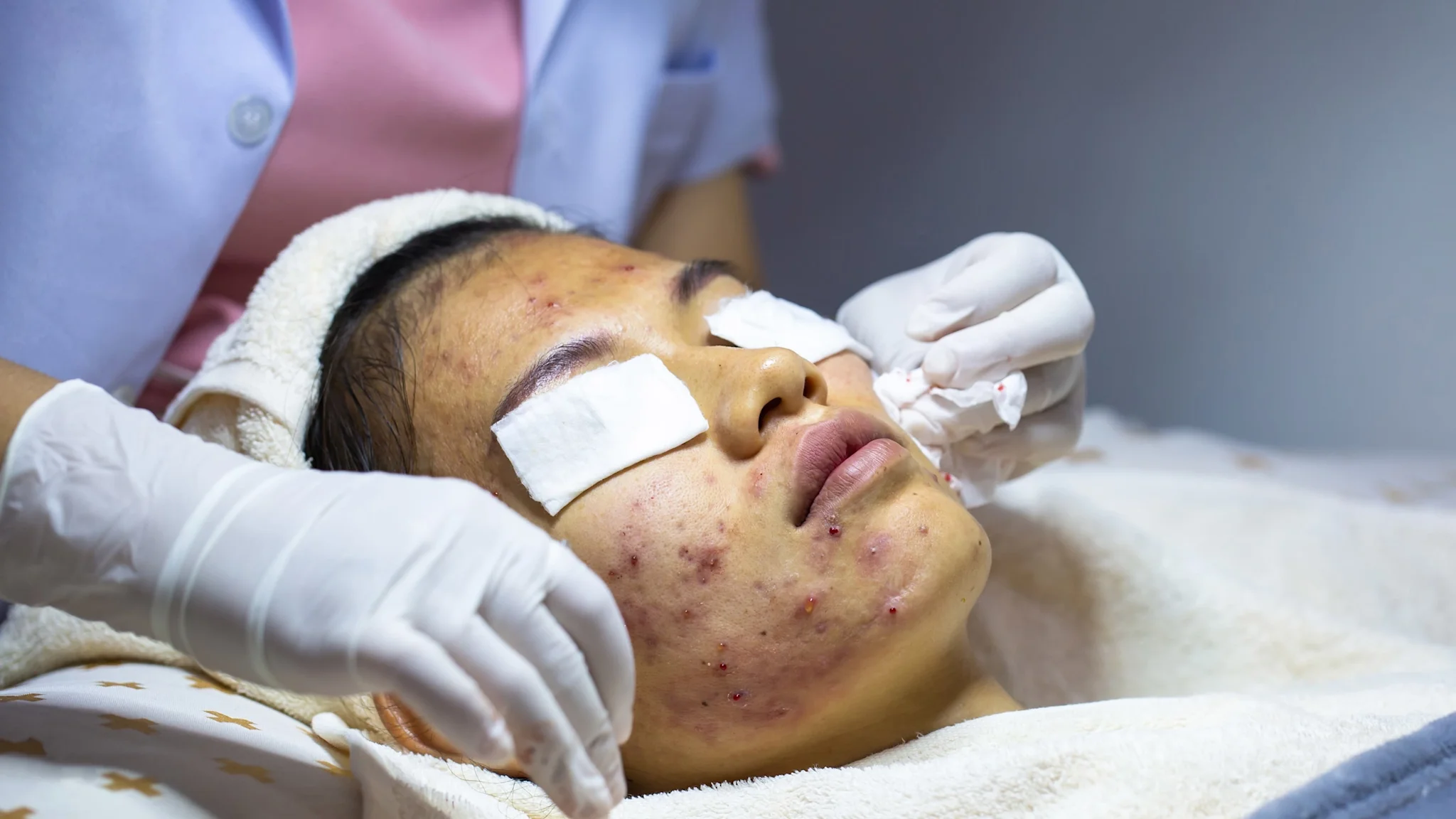 How to Get Rid of Acne: 4 Things to Try - GoodRx