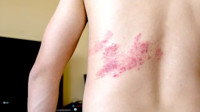 What Is Shingles, and How Do You Get It?