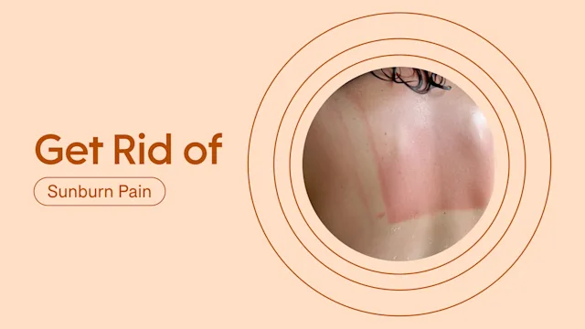 Health: Patient experiences: Sunburn rid featured image