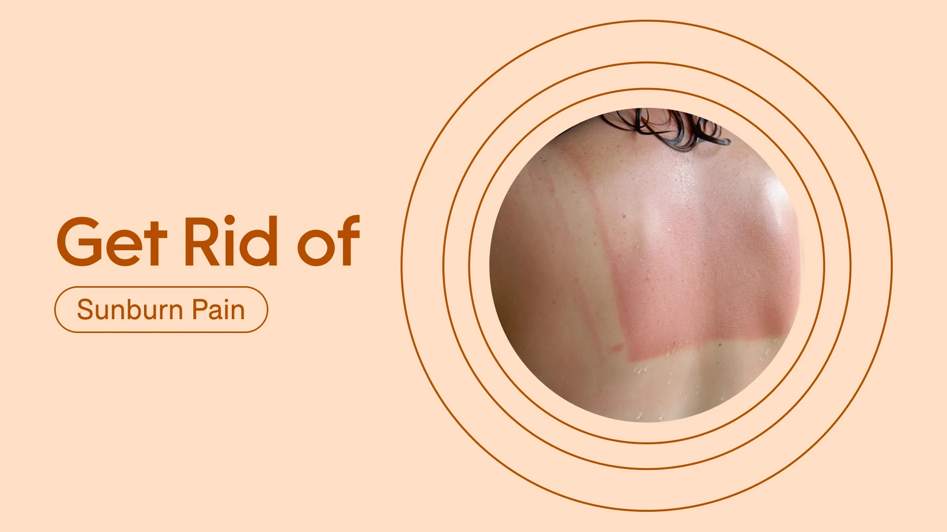 A custom graphic includes a circular, cropped image of a person’s sunburned back and test that reads, “Ged Rid of Sunburn Pain.”