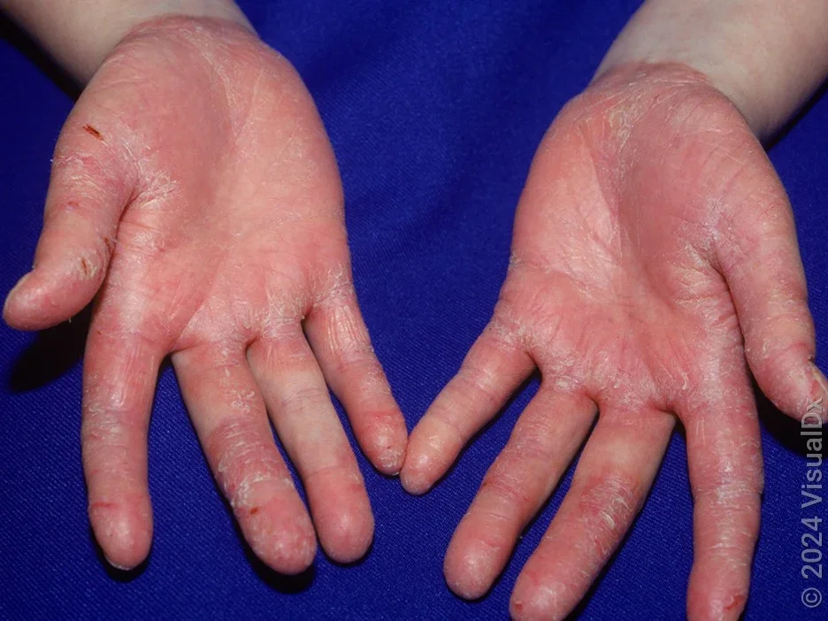 Palms with red, scaly patches and cuts from psoriasis. 