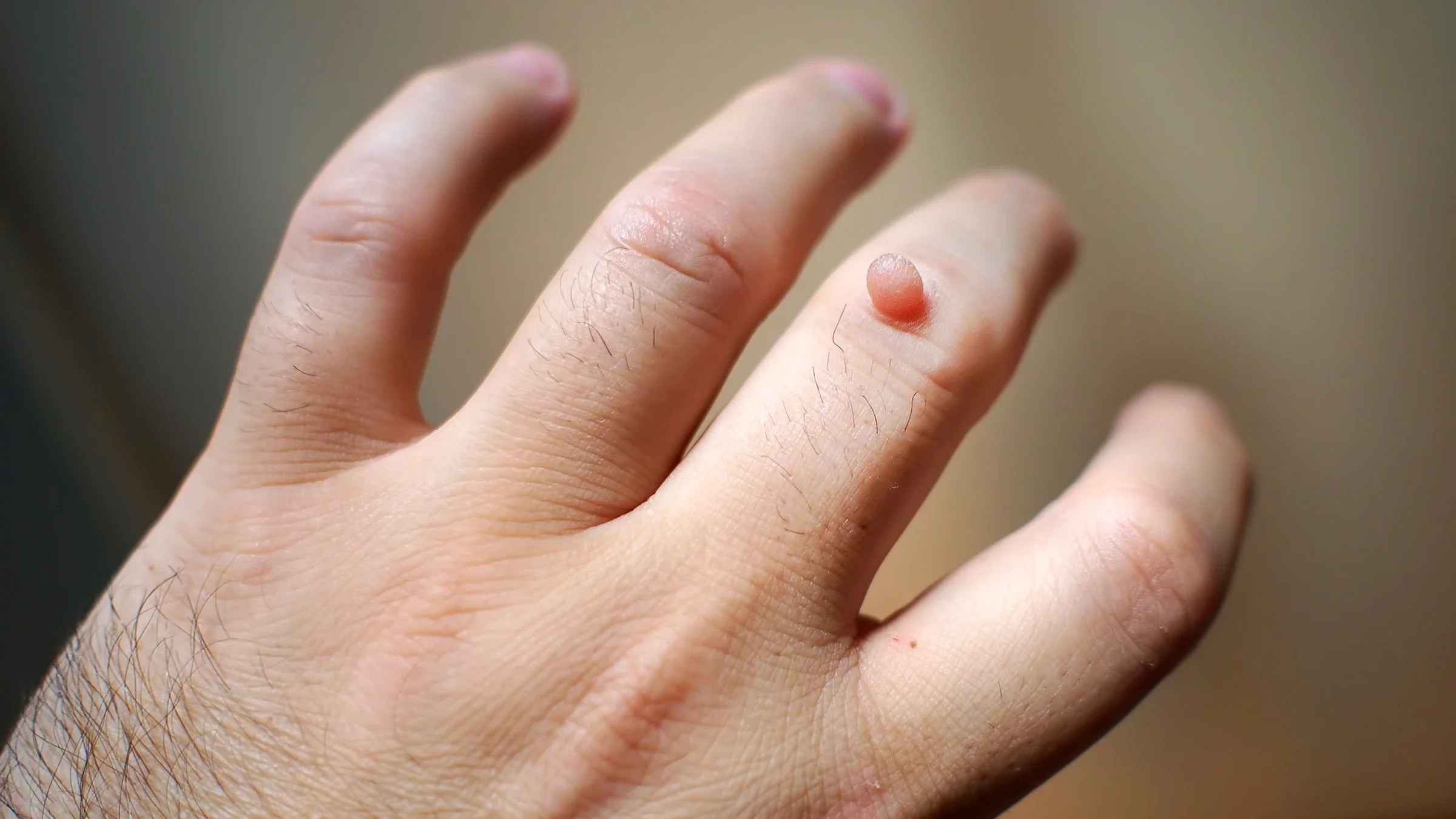 A close-up look at a wart on a finger.