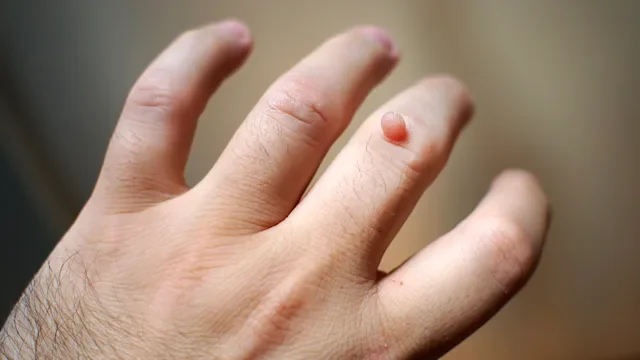 Dermatology: closeup wart on finger 503048090