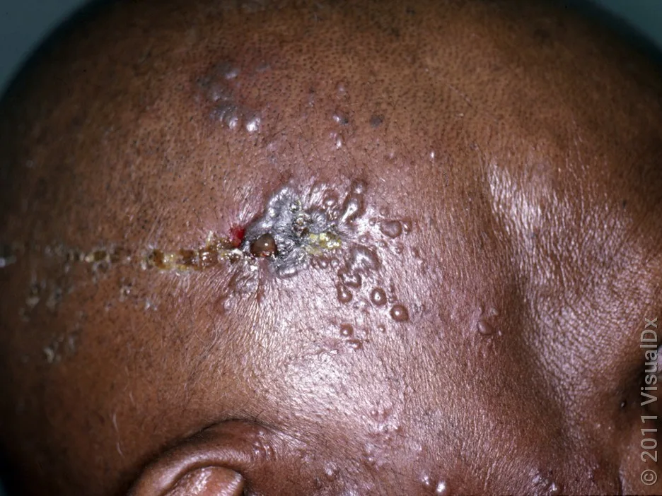 Close-up of the side of the head with shingles rash with some crusting. 
