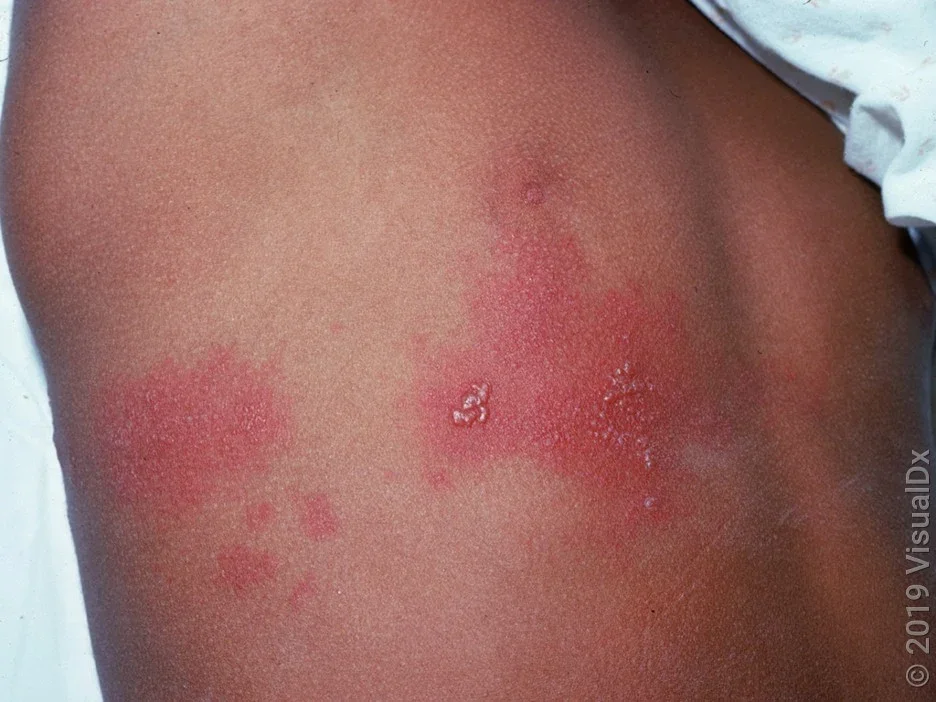 A look at a torso with red patches and blisters from early-stage shingles rash. 