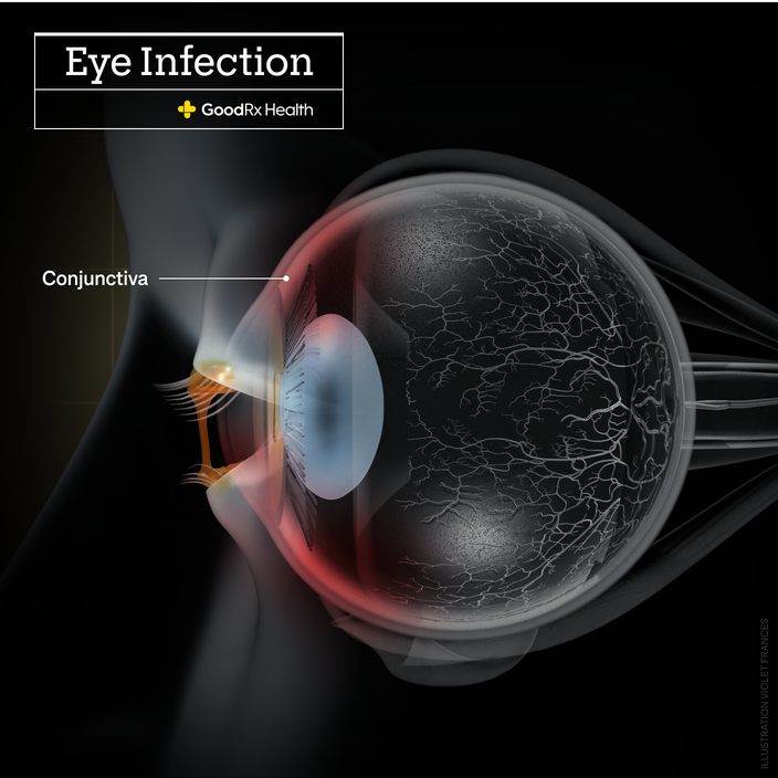A 3D illustration of an eye infection highlighting the conjunctiva. 