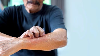 Autoimmune: closeup man scratching forearm 1834504711