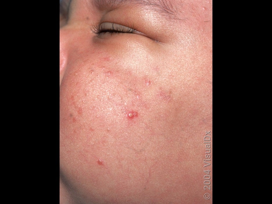 How to Know If Your Baby Has Acne, Plus Signs to Look For GoodRx