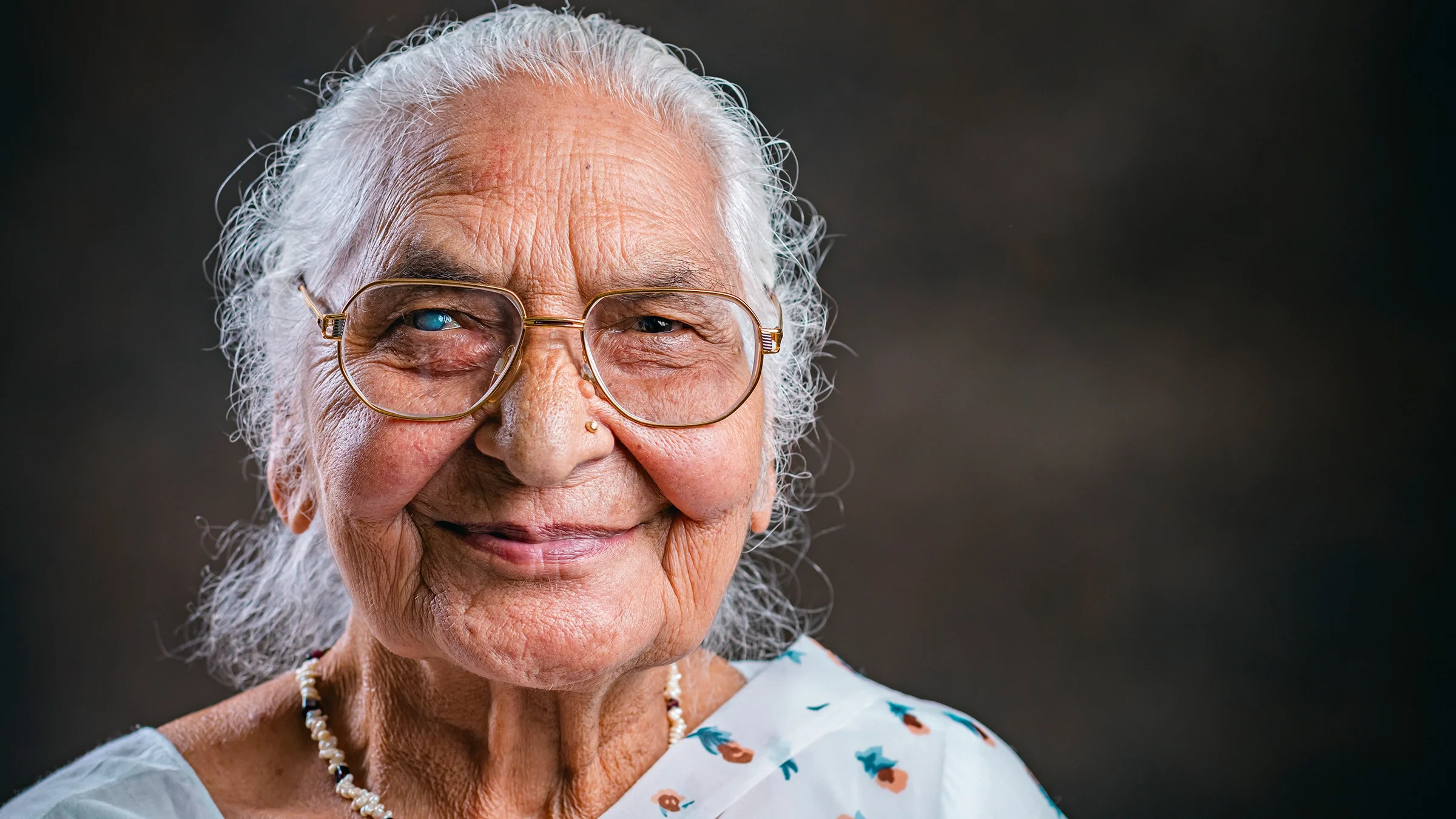 A woman has a cataract in her right eye.