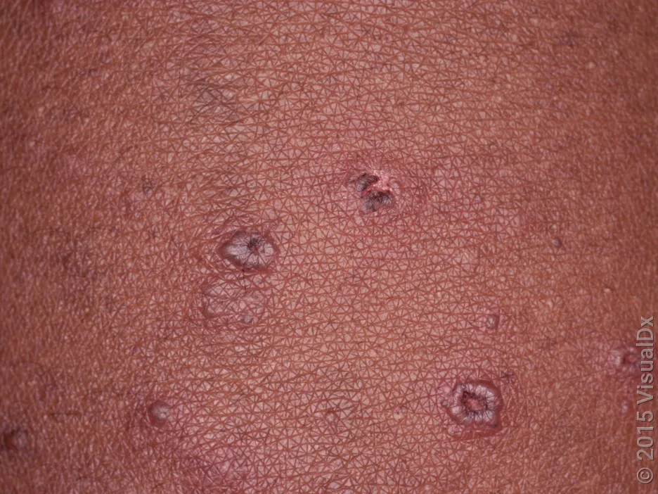 Close-up of chickenpox blisters.