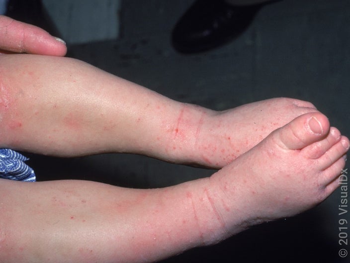 Close-up of eczema (atopic dermatitis) on legs of an infant.