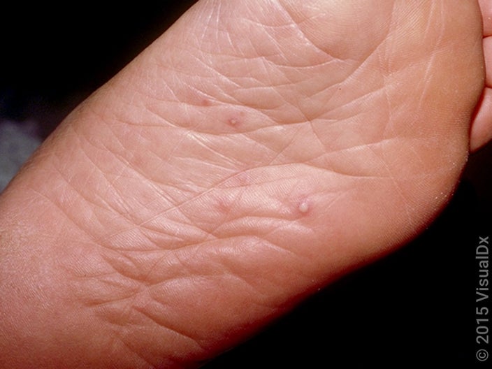 Early signs of hand, foot, and mouth disease mixed with more advanced blisters on the foot. 