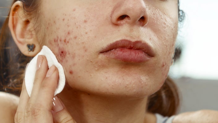 Close-up of someone wiping the acne on their lower face.
