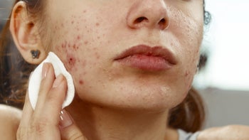 Acne: close-up lower face cotton wiping acne 539247835