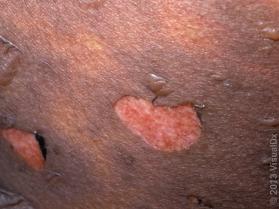 Blisters and peeled skin caused by SJS rash. 