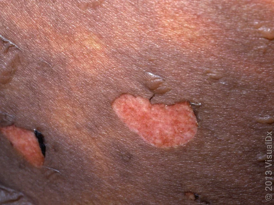 Blisters and peeled skin caused by SJS rash.