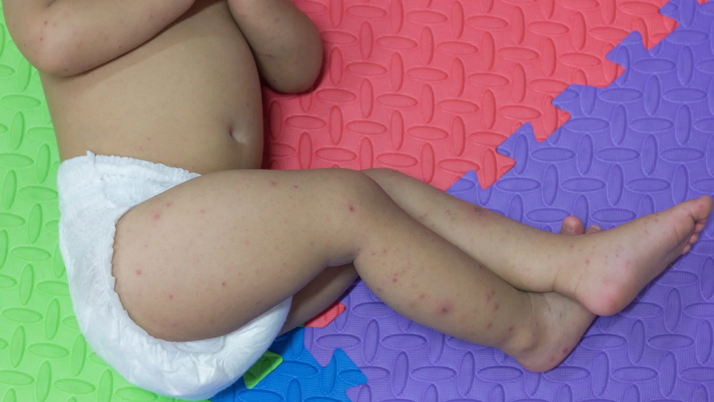 A cropped image of a baby with hand, foot, and mouth disease against a colorful background.