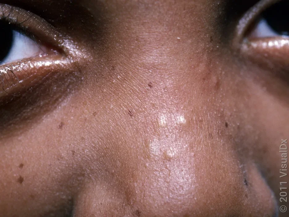 Close-up of milia bumps on the nose.