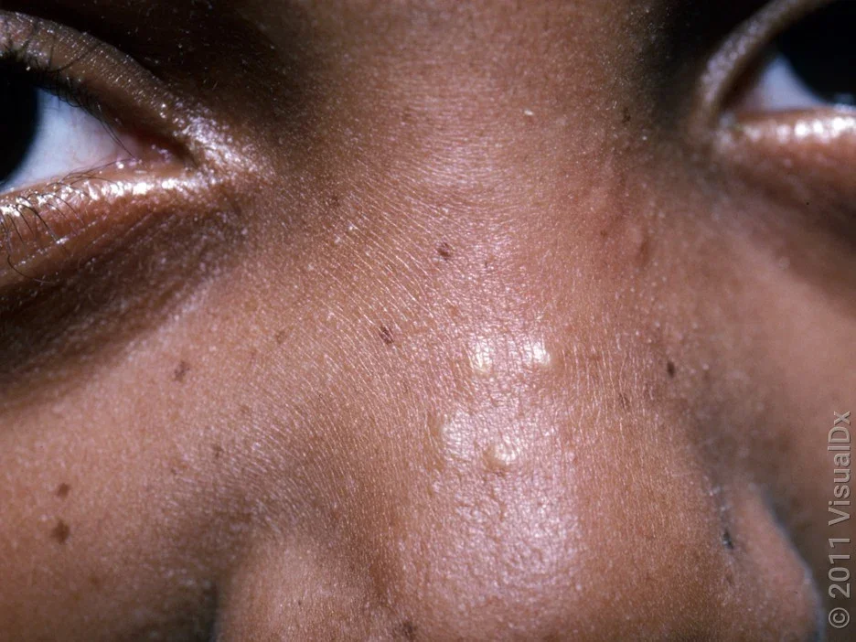 Close-up of milia bumps on the nose.