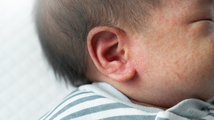 Close-up of eczema on and in an infant’s ear.