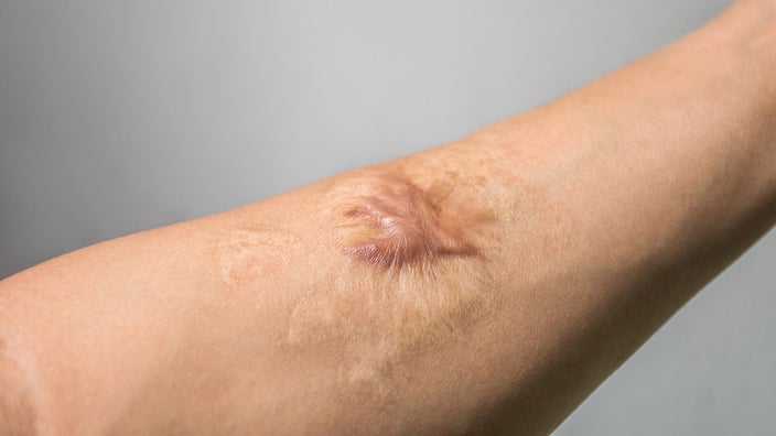Close-up cropped shot of a person's arm with a keloid scar.