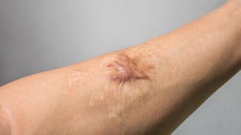 Health: Procedures: keloid scar arm-1022633142