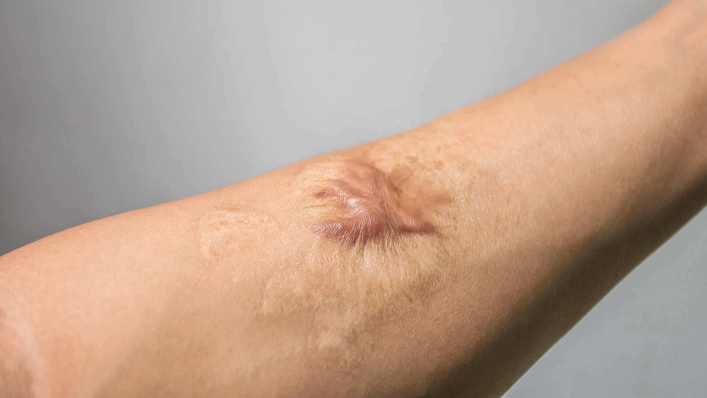 Close-up cropped shot of a person's arm with a keloid scar.
