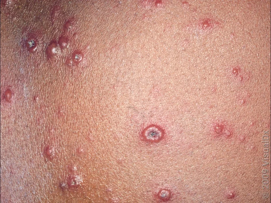 Chickenpox blisters in different stages of evolution. 