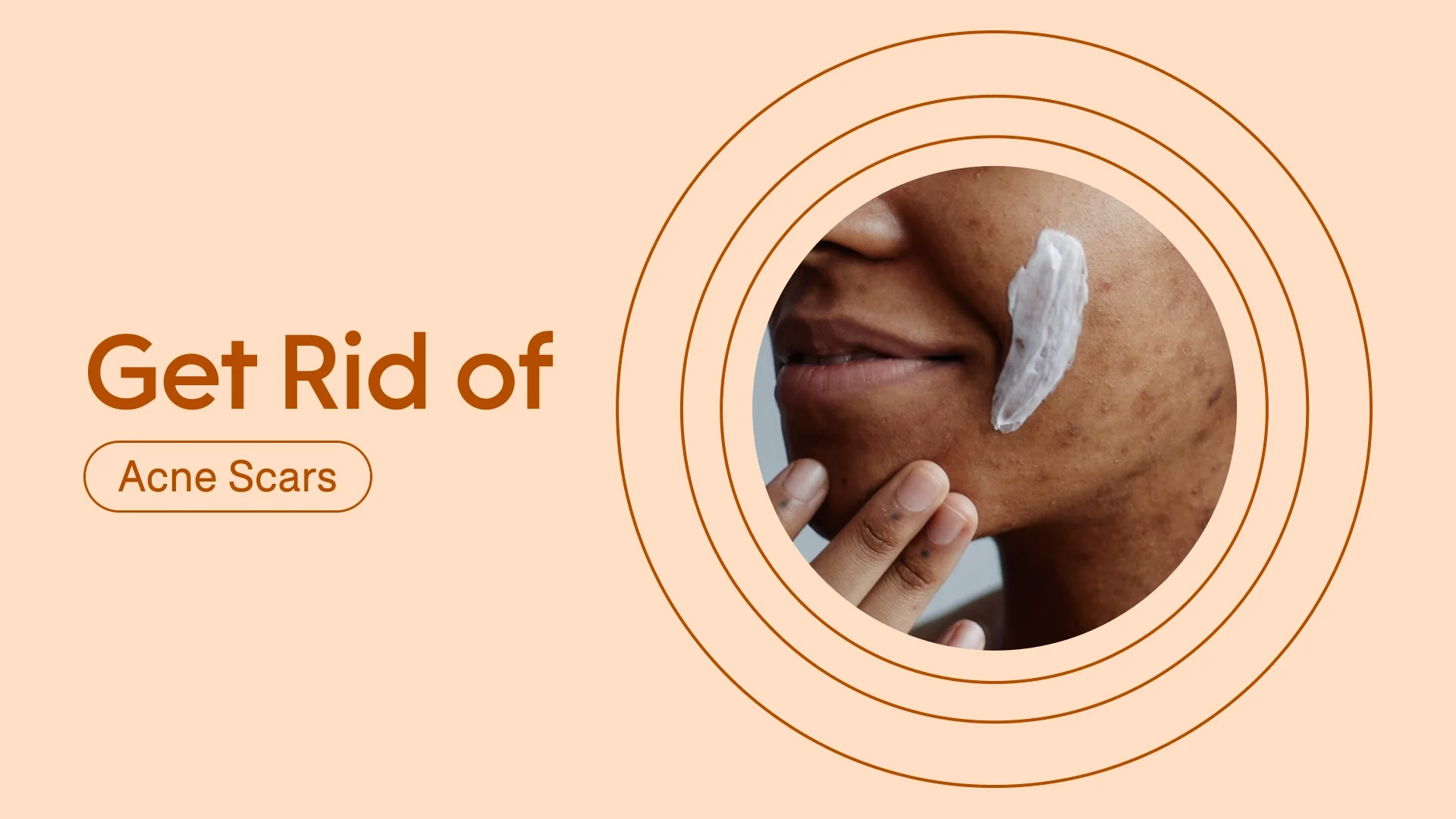 Light red background with dark red text on the left side reading: “Get Rid of Acne Scars.” On the right side, there is a circular cropped image of a woman putting cream on her acne scars. The photo is surrounded by red radial lines.