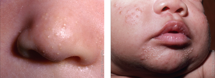 Left: Close-up of an infant's nose with many tiny, smooth white and yellow bumps. Right: Many small, white bumps on the chin and cheek in an infant with both milia and baby acne.
