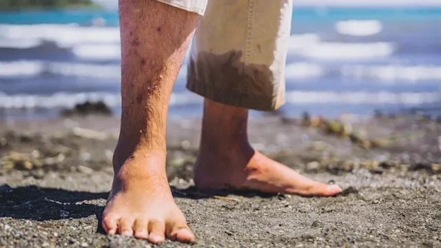 Dermatology: keratosis pilaris beach 1370943837