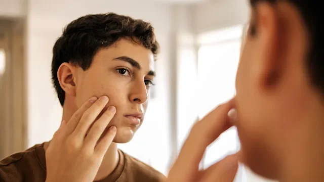 Twyneo: teenager with acne 2258464645