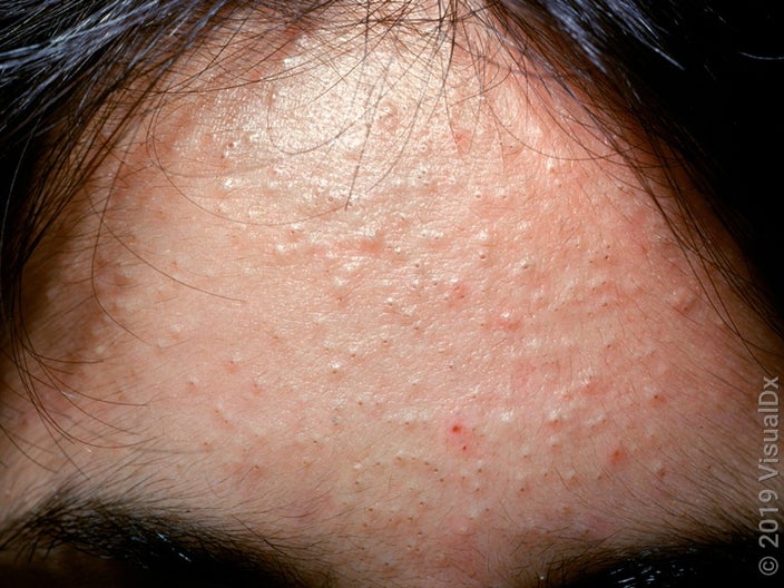 Close-up of the forehead with many whiteheads and blackheads.